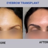 BKS Hair Restoration gallery