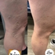 Vein Treatment Center