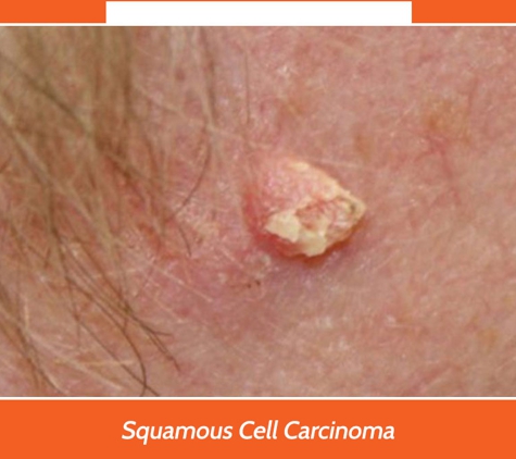 Port Macquarie Skin Cancer Clinic - Port Macquarie, NSW. Squamous Cell Carcinoma
