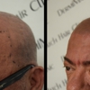 DermiMatch Hair Clinic - SMP (scalp micropigmentation) gallery